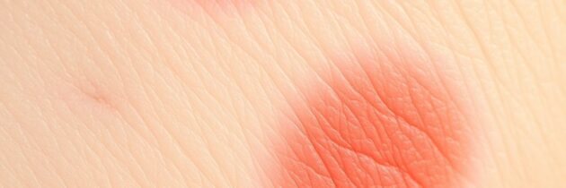 Ektoina na rumień: jak rozpoznać normę i kiedy warto sięgnąć po wsparcie skóry