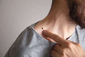 Brodawki wracają mimo leczenia – kiedy warto skonsultować je z dermatologiem?